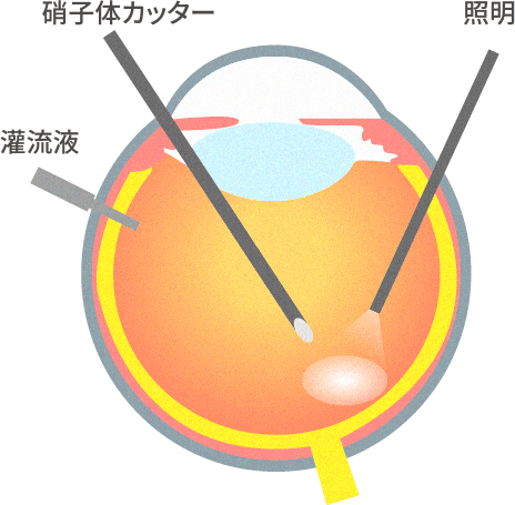硝子体手術　イメージ